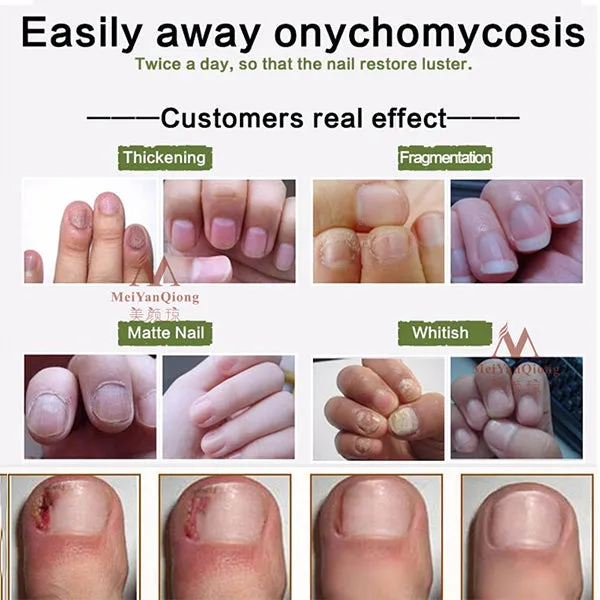 Nail Repair Cream